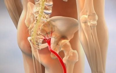 WHAT IS SCIATICA?